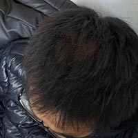 薄毛(男性型脱毛症)